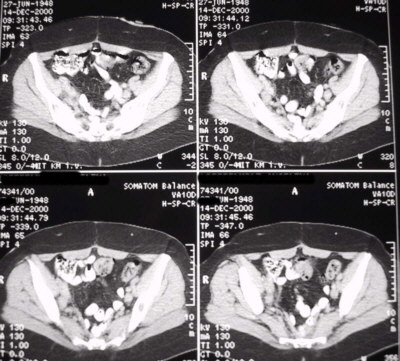 CT with colorectal recurrence