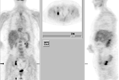 PET with colorectal recurrence