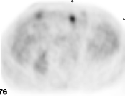 PET with mesenchymal tumor recurrence