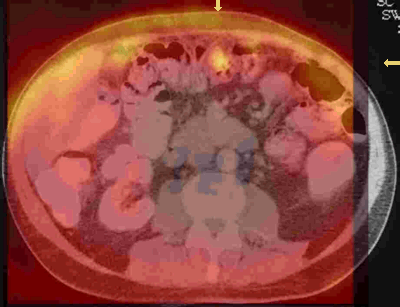 PET-CT with mesenchymal tumor recurrence