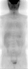 normal PET: view from side